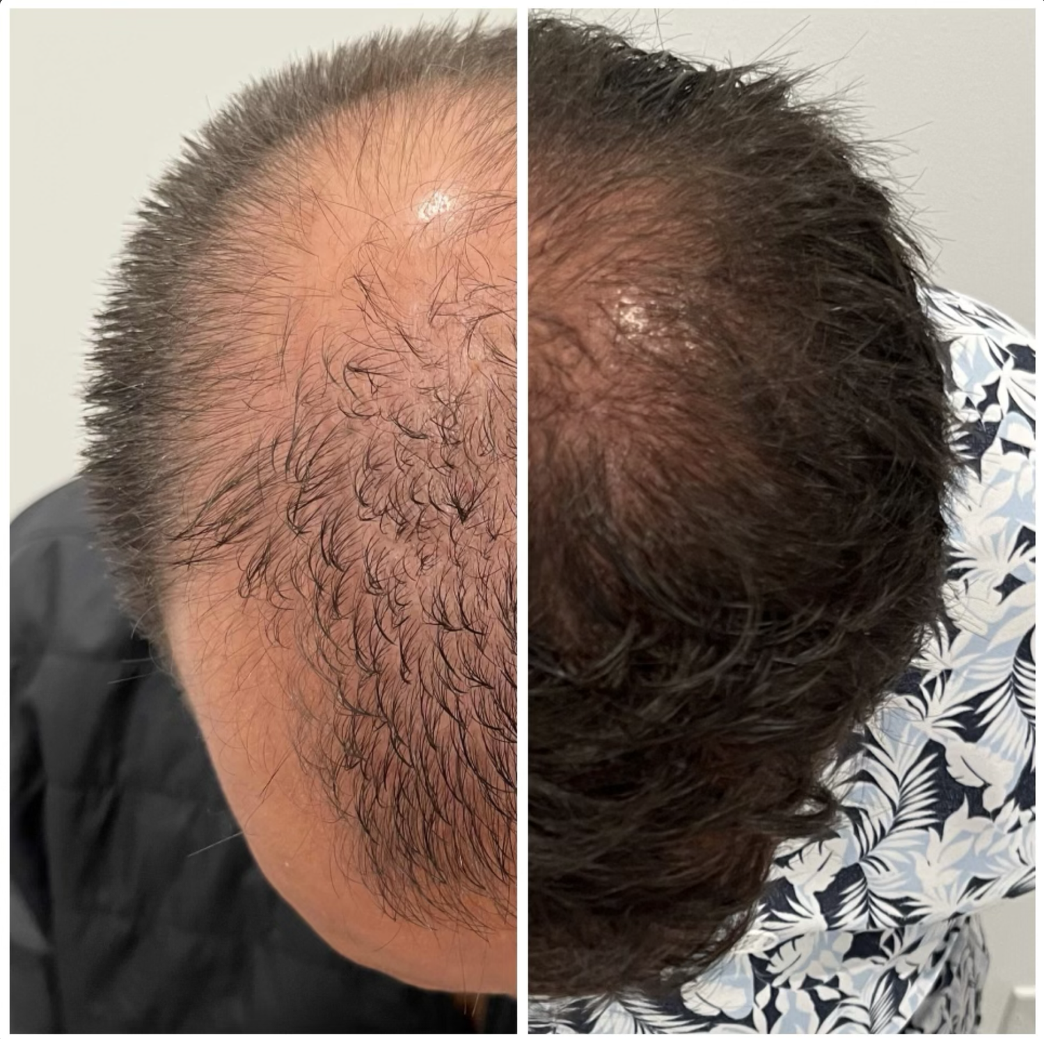 Hair Transplant Chicago