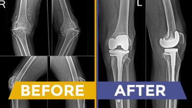Best Knee Replacement Surgeon in Kadapa