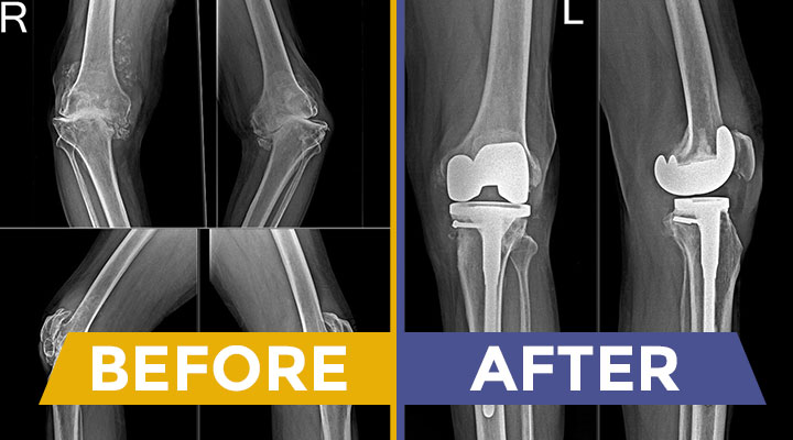 Best Knee Replacement Surgeon in Kadapa