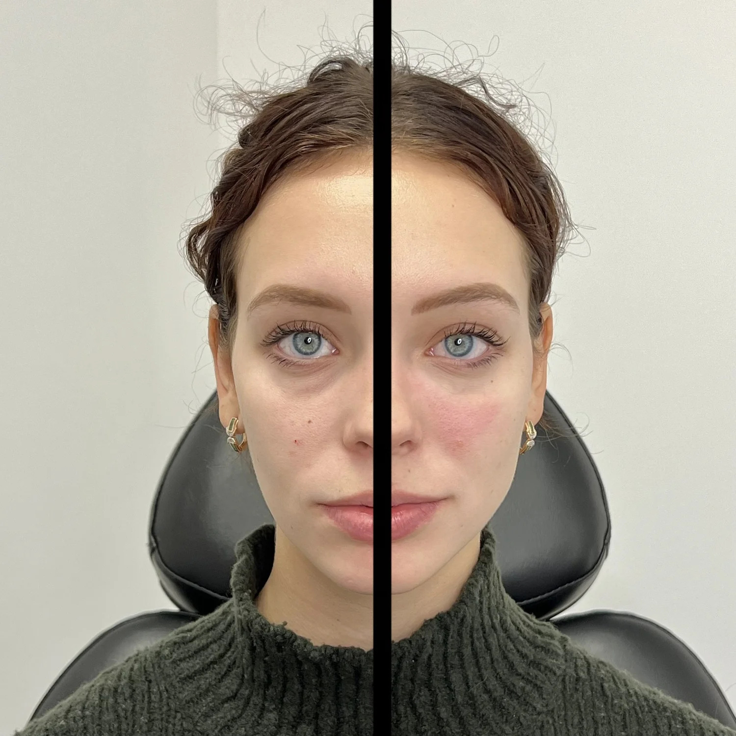 Skin rejuvenation Chicago